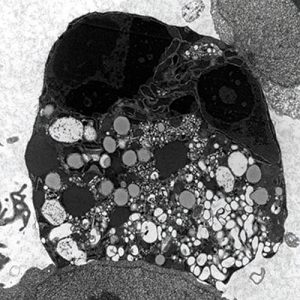 Cell death is studied using electron microscopy. The image shows a cell undergoing necroptosis, a type of cell death that takes place in tissues and results in inflammation. The image shows the fragmentation of the cell nucleus and the formation of many vacuoles and lipid droplets (the grey-looking circles). The image was taken in Dr. Abu-Asab’s laboratory.